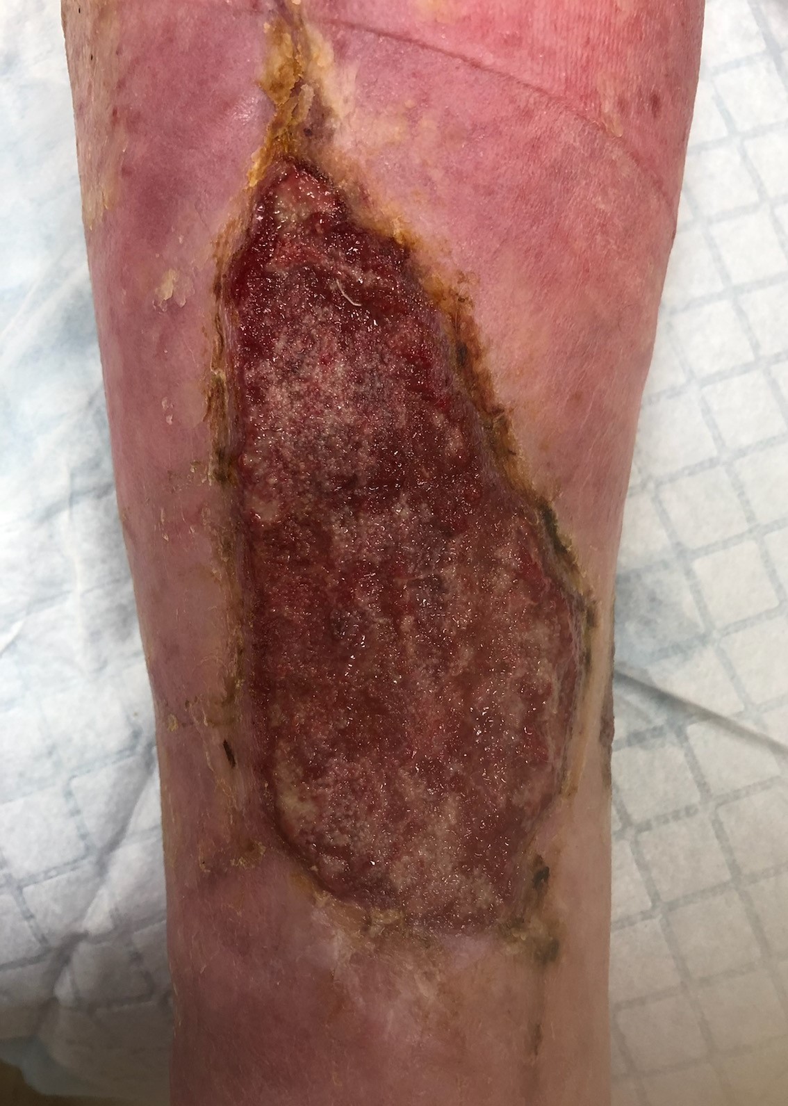 Top wound following first treatment plan with Restore Wound Care