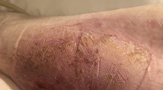 Left leg after 21 days of treatment with Restore Wound Care